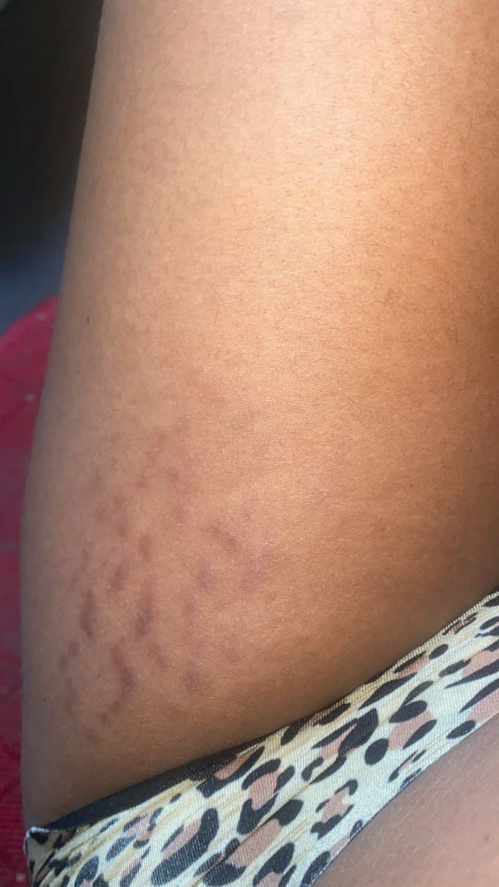Vergetures récentes sur la cuisse